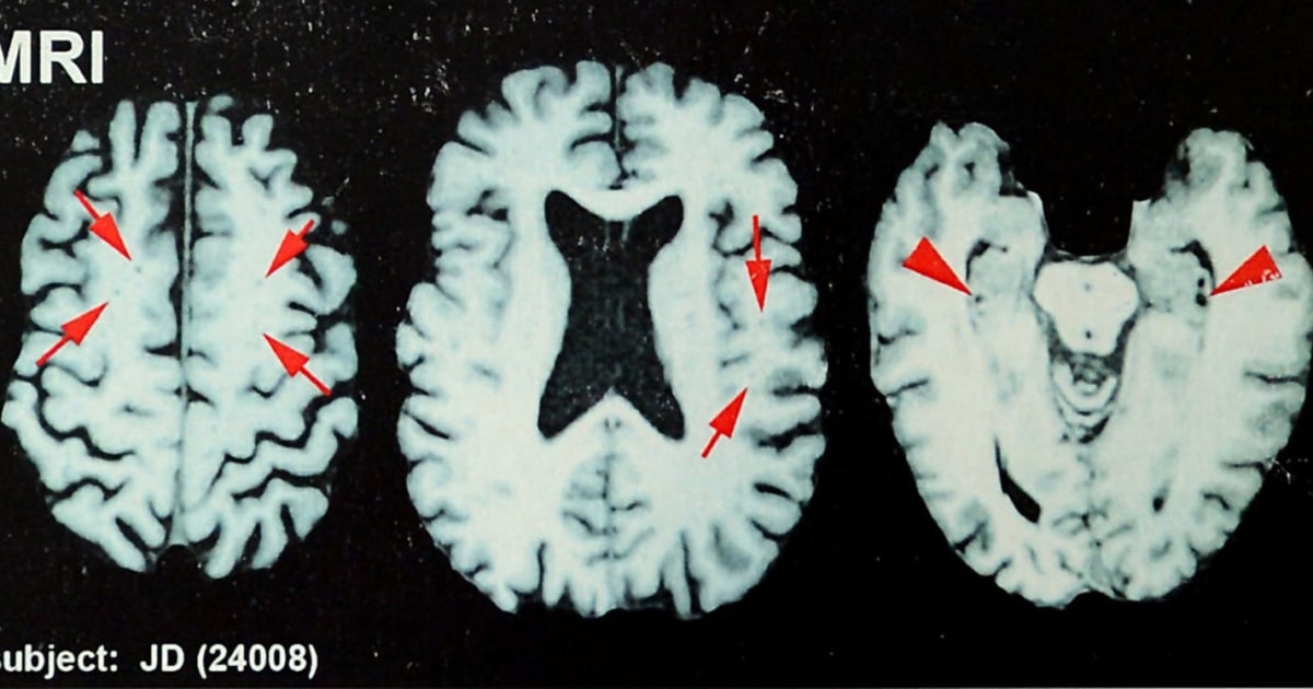 A third of former NFL players surveyed think they have CTE: study